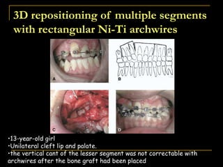 3D repositioning of multiple segments
with rectangular Ni-Ti archwires
•13-year-old girl
•Unilateral cleft lip and palate.
•the vertical cant of the lesser segment was not correctable with
archwires after the bone graft had been placed
 