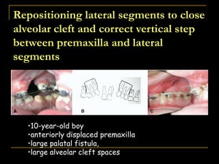 Repositioning lateral segments to close
alveolar cleft and correct vertical step
between premaxilla and lateral
segments
•10-year-old boy
•anteriorly displaced premaxilla
•large palatal fistula,
•large alveolar cleft spaces
 