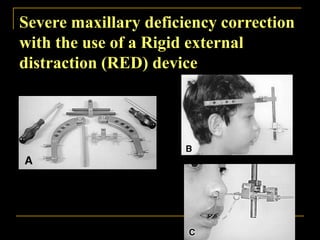 Severe maxillary deficiency correction
with the use of a Rigid external
distraction (RED) device
 