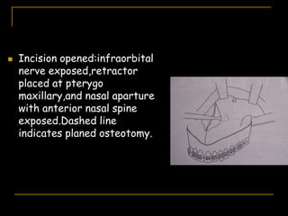  Incision opened:infraorbital
nerve exposed,retractor
placed at pterygo
maxillary,and nasal aparture
with anterior nasal spine
exposed.Dashed line
indicates planed osteotomy.
 
