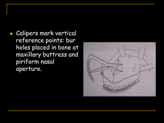  Calipers mark vertical
reference points: bur
holes placed in bone at
maxillary buttress and
piriform nasal
aperture.
 