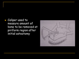  Caliper used to
measure amount of
bone to be removed at
piriform region after
initial osteotomy
 