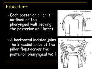 Procedure
 Each posterior pillar is
outlined on the
pharyngeal wall ,leaving
the posterior wall intact
 A horizontal incision joins
the 2 medial limbs of the
pillar flaps across the
posterior pharyngeal wall
 