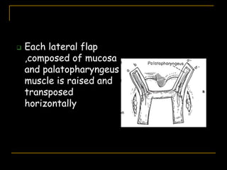  Each lateral flap
,composed of mucosa
and palatopharyngeus
muscle is raised and
transposed
horizontally
 