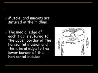  Muscle and mucosa are
sutured in the midline
 The medial edge of
each flap is sutured to
the upper border of the
horizontal incision and
the lateral edge to the
lower border of the
horizontal incision
 