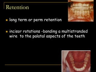 Retention
 long term or perm retention
 incisor rotations -bonding a multistranded
wire to the palatal aspects of the teeth
 