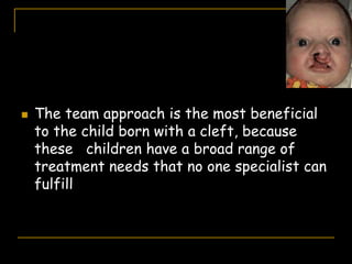  The team approach is the most beneficial
to the child born with a cleft, because
these children have a broad range of
treatment needs that no one specialist can
fulfill
 