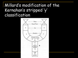 Millard’s modification of the
Kernahan’s stripped ‘y’
classification
 
