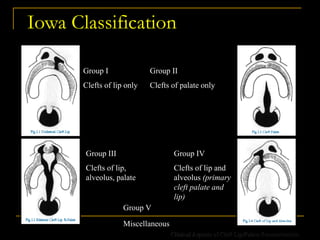 Iowa Classification
Group I
Clefts of lip only
Group II
Clefts of palate only
Group III
Clefts of lip,
alveolus, palate
Group IV
Clefts of lip and
alveolus (primary
cleft palate and
lip)
Group V
Miscellaneous
Clinical Aspects of Cleft Lip/Palate Reconstruction
 