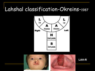 Lahshal classification-Okreins-1987
LAH-R
 