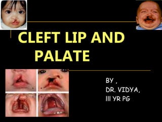 CLEFT LIP AND
PALATE
BY ,
DR. VIDYA,
lll YR PG
 