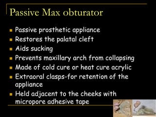 Passive Max obturator
 Passive prosthetic appliance
 Restores the palatal cleft
 Aids sucking
 Prevents maxillary arch from collapsing
 Made of cold cure or heat cure acrylic
 Extraoral clasps-for retention of the
appliance
 Held adjacent to the cheeks with
micropore adhesive tape
 