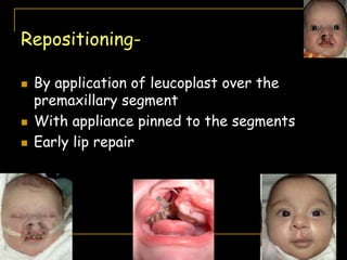 Repositioning-
 By application of leucoplast over the
premaxillary segment
 With appliance pinned to the segments
 Early lip repair
 