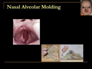 Nasal Alveolar Molding
 