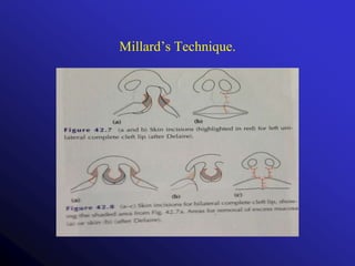 Cleft lip and palate.pptx