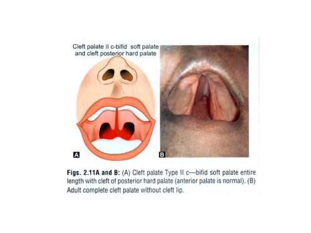 CLEFT LIP AND CLEFT PALATE- Embryology and management | PPTX