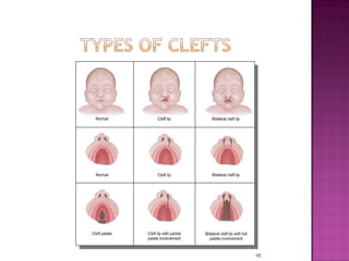 CLEFT LIP AND PALATE - etiology and managemnt | PPT