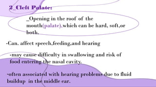 cleft lip and palate Management of Cleft Lip and Palate | PPTX
