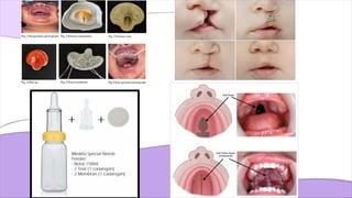 cleft lip and palate Management of Cleft Lip and Palate | PPTX