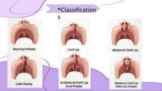 cleft lip and palate Management of Cleft Lip and Palate | PPTX