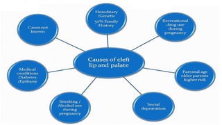 cleft lip and palate Management of Cleft Lip and Palate | PPTX