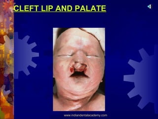 CLEFT LIP AND PALATE

www.indiandentalacademy.com

 