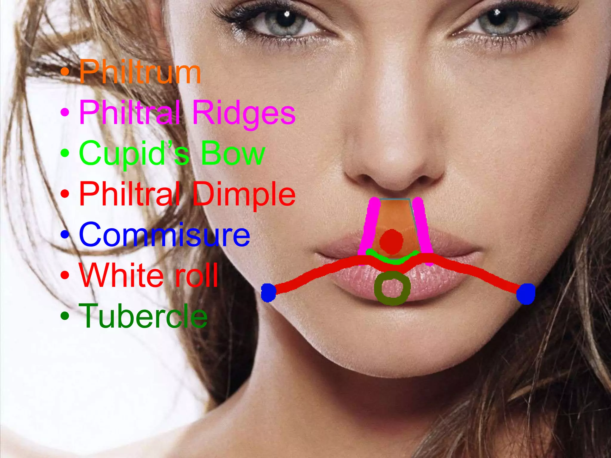 • Philtrum
• Philtral Ridges
• Cupid’s Bow
• Philtral Dimple
• Commisure
• White roll
• Tubercle
 