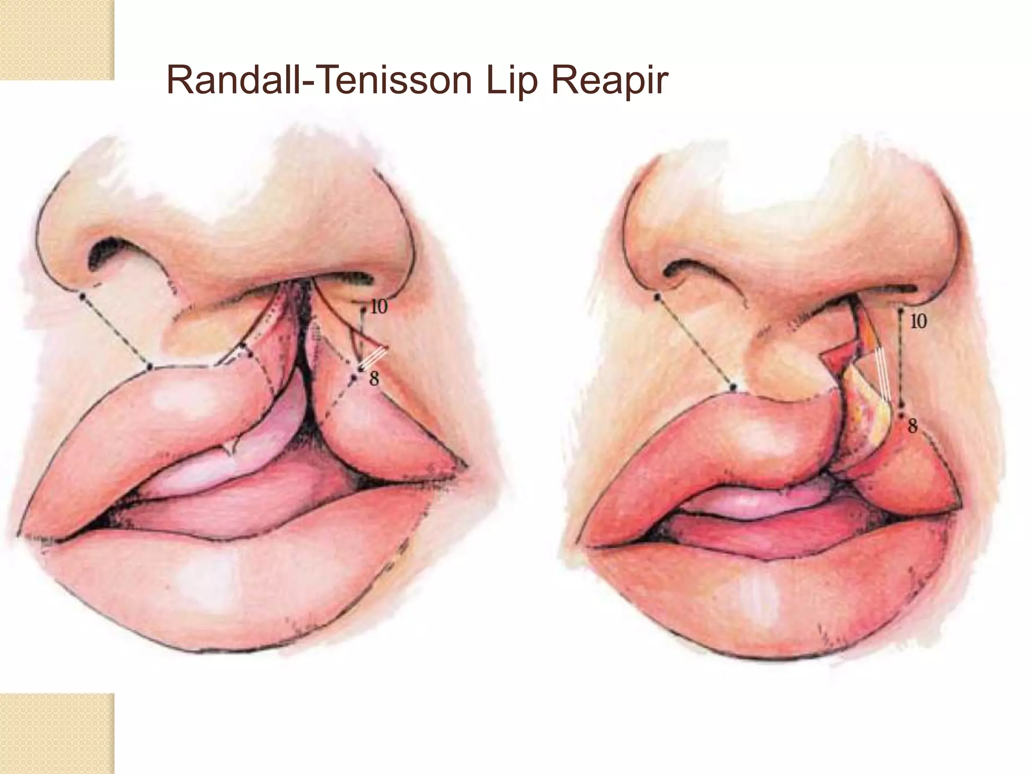 Randall-Tenisson Lip Reapir
 