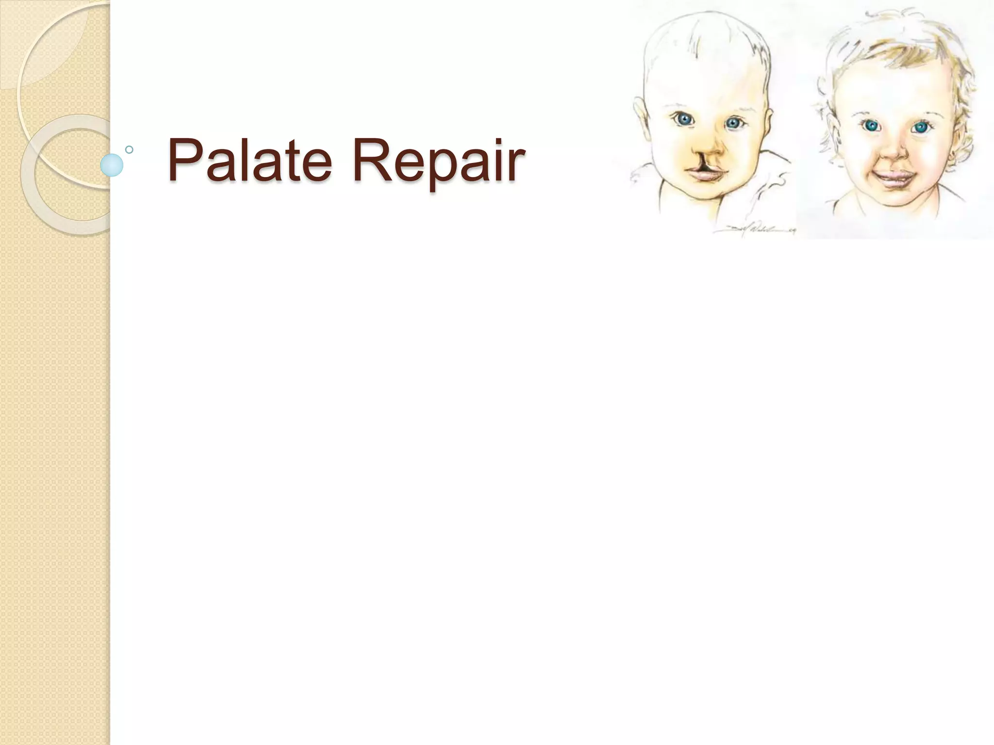 Palate Repair
 