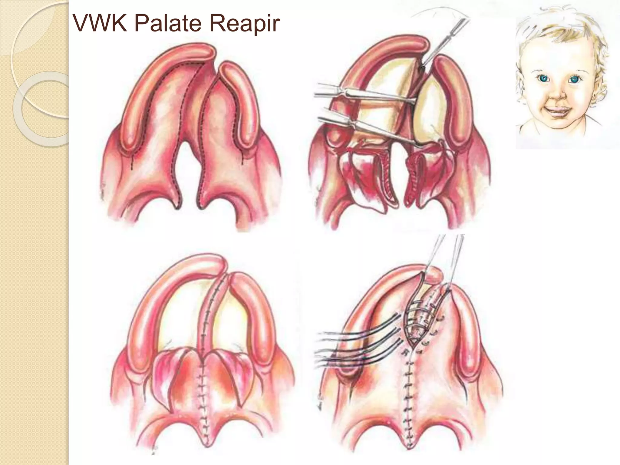 VWK Palate Reapir
 