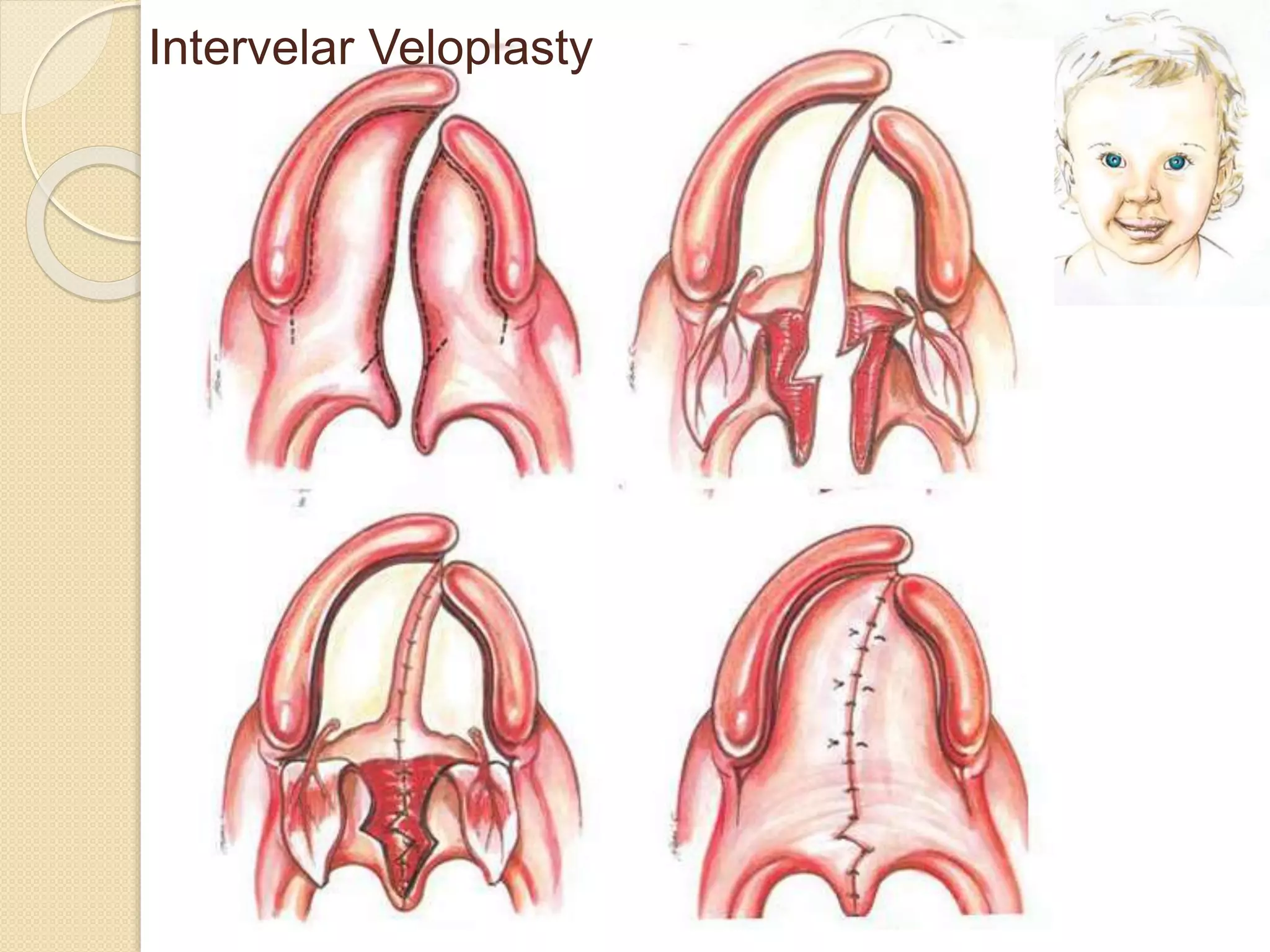 Intervelar Veloplasty
 