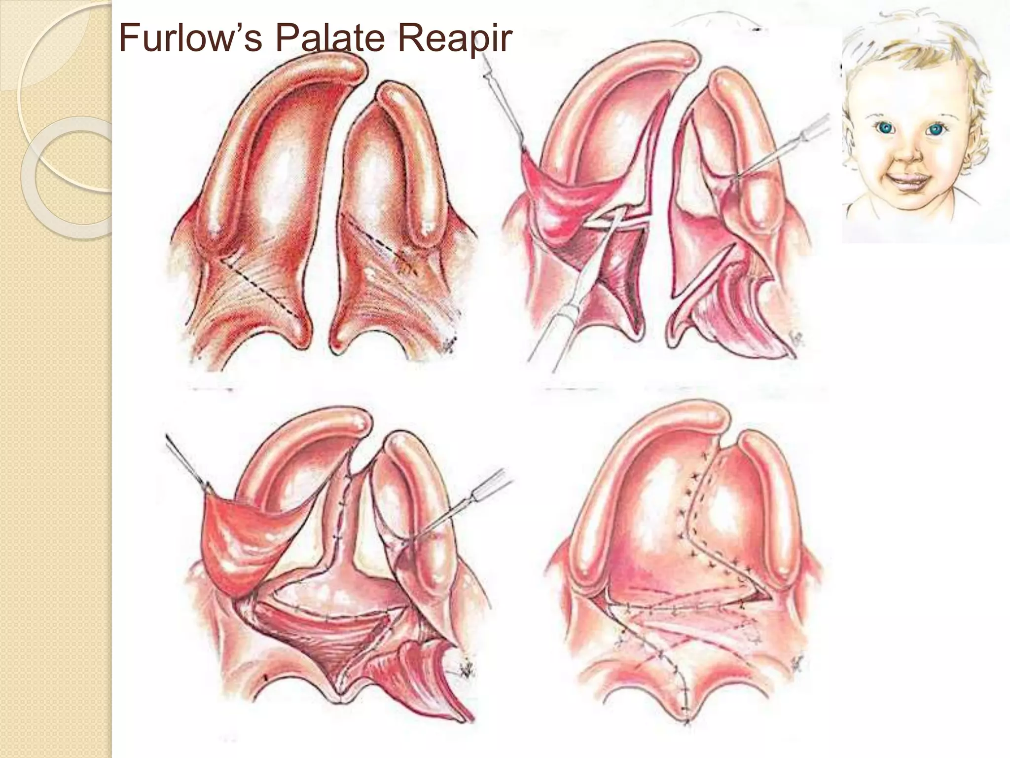 Furlow’s Palate Reapir
 