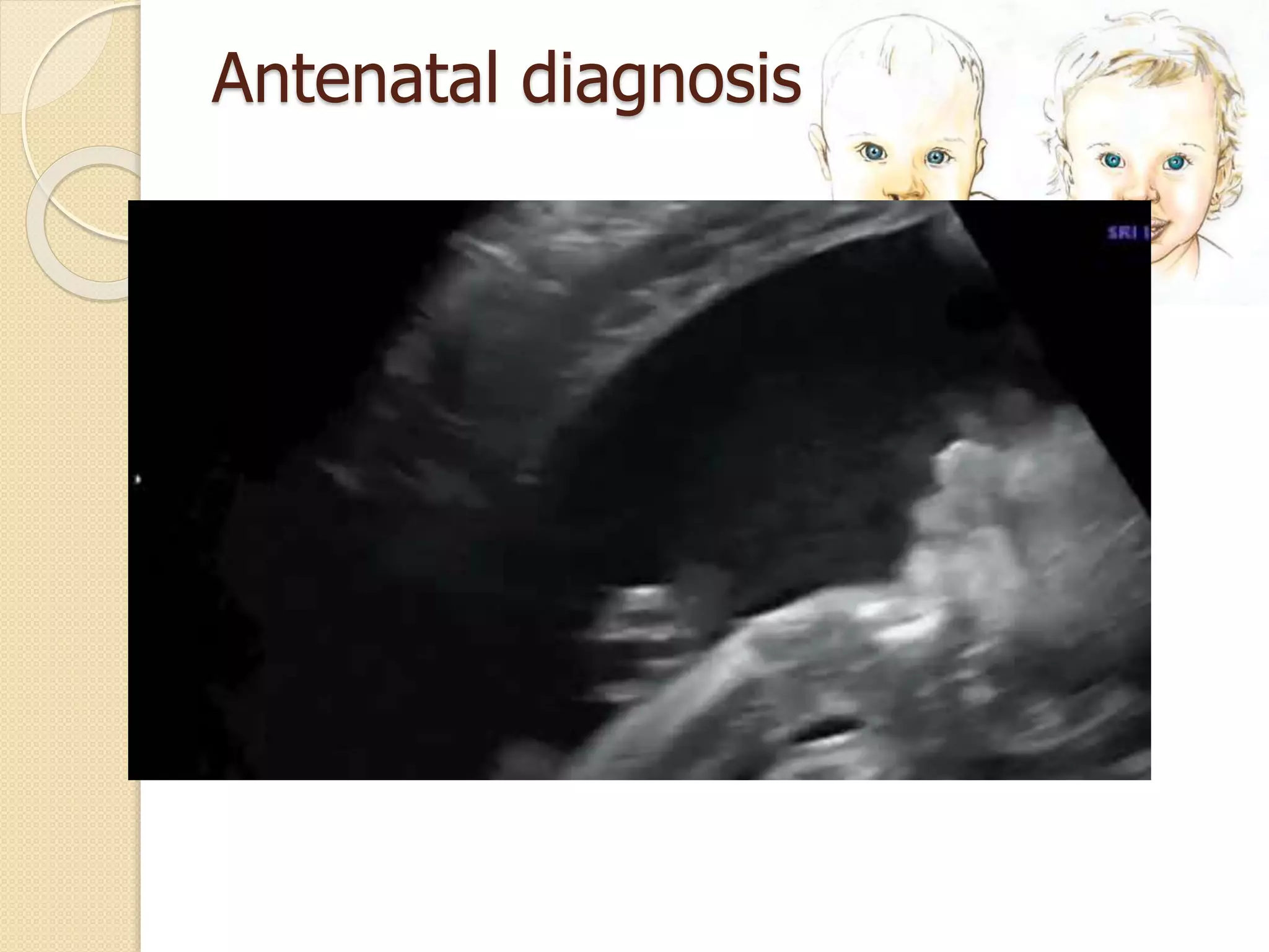 Antenatal diagnosis
 