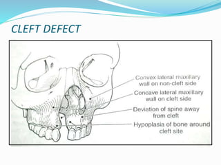 Systemic Cleft CLEFT LIP AND PALATE craniofacial anomalies | PPTX