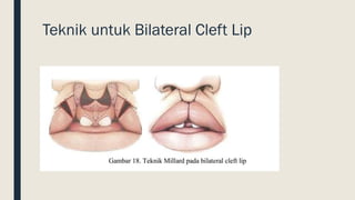 Cleft lip and palate | PDF