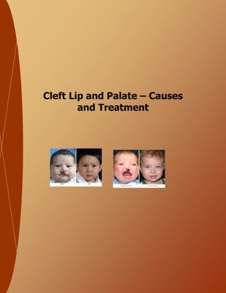 Cleft Lip and Palate – Causes
and Treatment
 