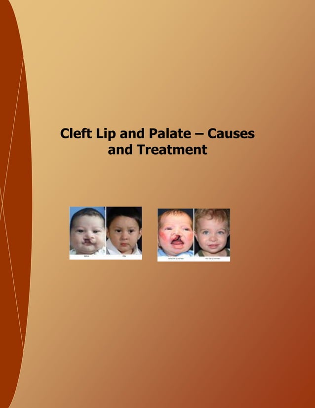 Cleft Lip and Palate Causes and Treatment PDF