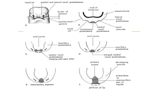 CLEFT LIP AND PALATE ETIOLOGY AND CLASSIFICATION.pptx