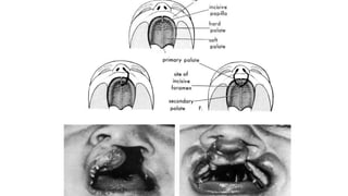 CLEFT LIP AND PALATE ETIOLOGY AND CLASSIFICATION.pptx