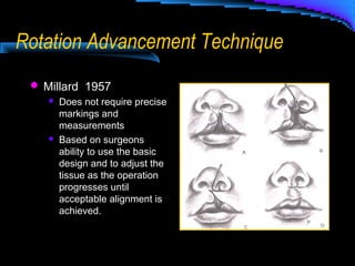 Rotation Advancement Technique
 Millard 1957
 Does not require precise
markings and
measurements
 Based on surgeons
ability to use the basic
design and to adjust the
tissue as the operation
progresses until
acceptable alignment is
achieved.
 