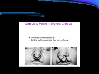Cleft lip and palate management