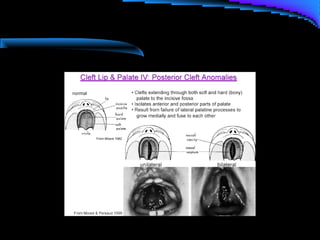 Cleft lip and palate management
