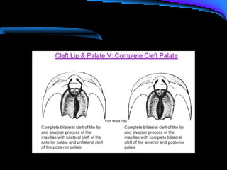 Cleft lip and palate management