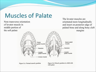 Note transverse orientation 
of levator muscle in 
middle portion of 
the soft palate 
The levator muscles are 
orientated more longitudinally 
and insert on posterior edge of 
palatal bone and along bony cleft 
margins 
 