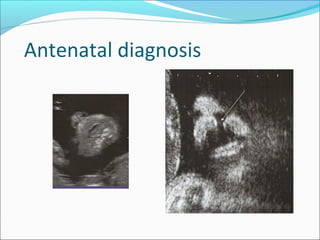 Antenatal diagnosis 
 