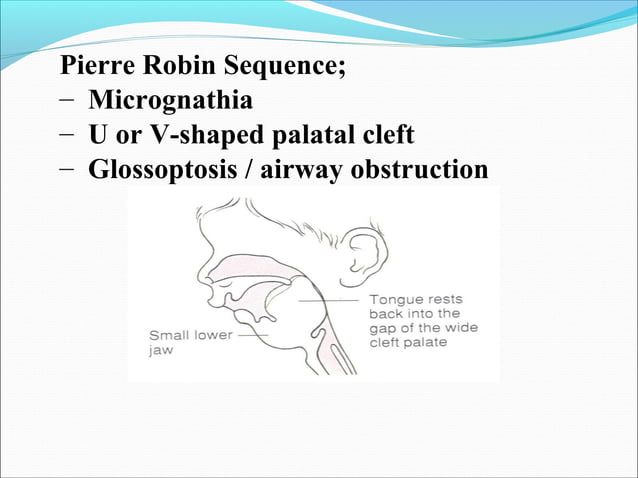 Cleft Lip And Palate Ppt PPT