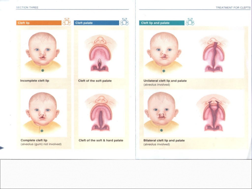 Cleft lip and palate ppt