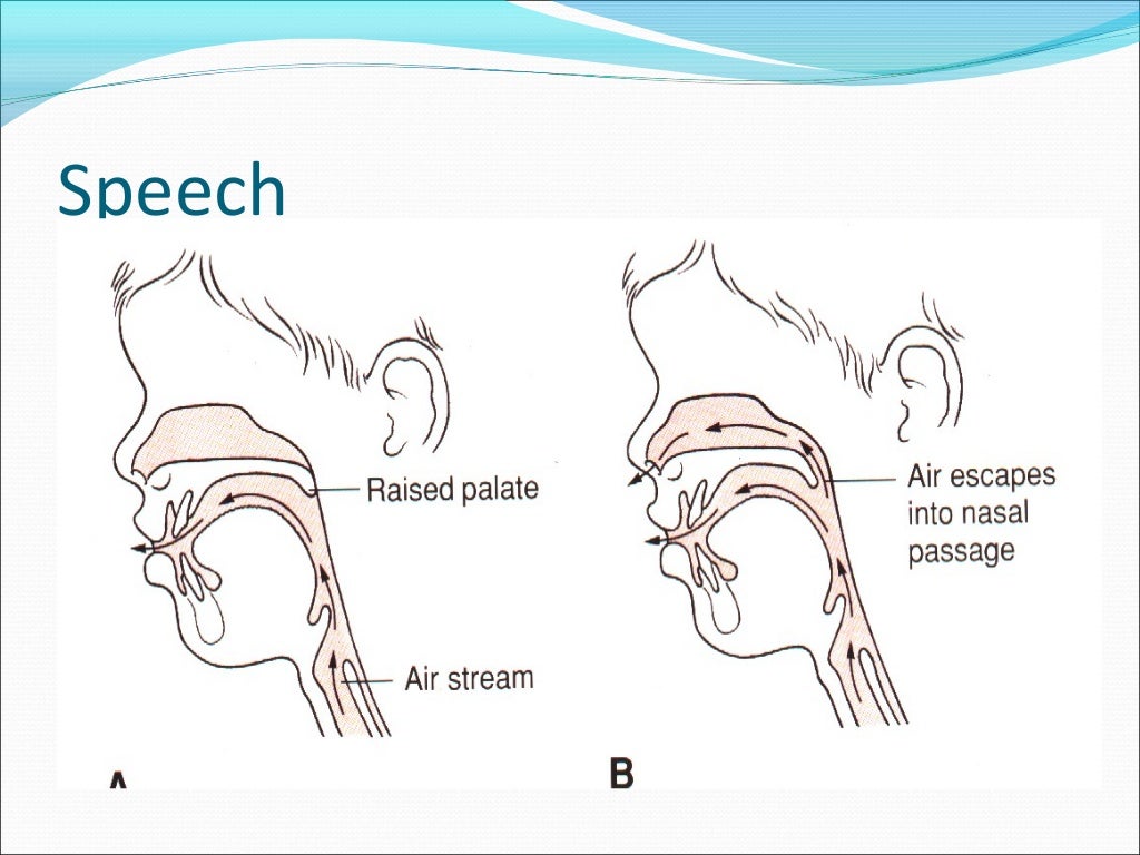 Cleft lip and palate ppt