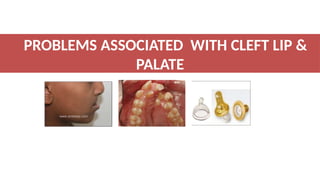 Management of CLEFT LIP AND PALATE SEMINAR | PPTX