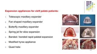 Expansion appliances for cleft palate patients:
1. Telescopic maxillary expander
2. Fan shaped maxillary expander
3. Butterfly maxillary expander
4. Spring jet for slow expansion
5. Banded / bonded rapid palatal expansion
6. Modified hyrax appliance
7. Quad helix
115
 